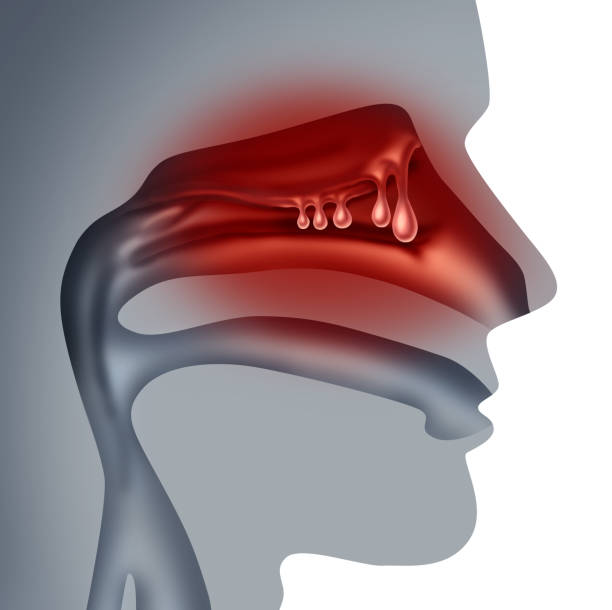 Nasal Polyp , Deviated septum