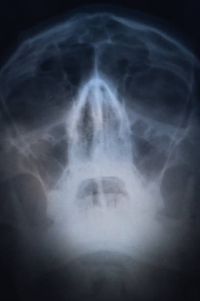 Deviated Septum